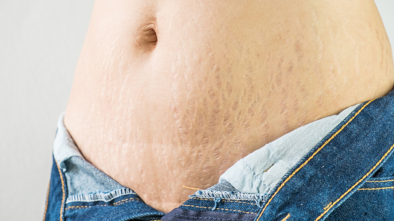 Minimize Unwanted Stretch Marks Before Swimsuit Season Hits