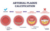 The Hidden Danger of Arterial Calcification: What You Need to Know