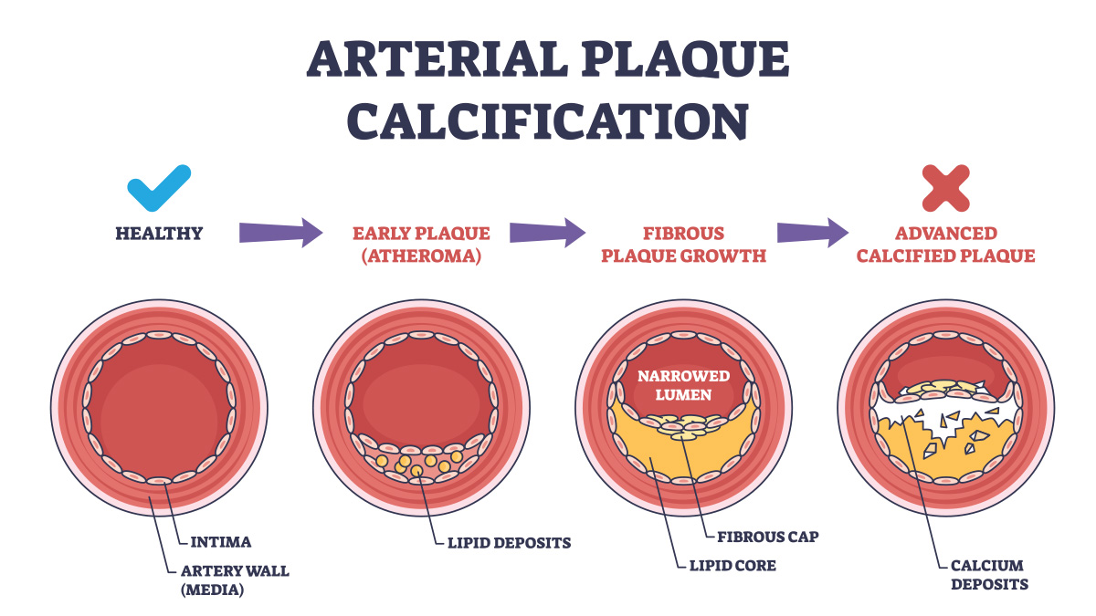 The Hidden Danger of Arterial Calcification: What You Need to Know
